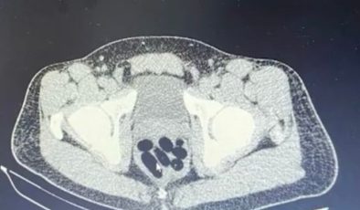 Yakalanan şahsın midesinden 1 kilo uyuşturucu çıktı